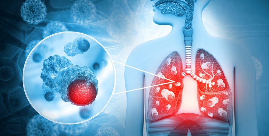 Ziua mondială de profilaxie și combatere a tuberculozei